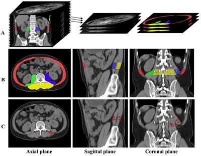 Segmentation of multi-regional skeletal muscle in abdominal CT image for cirrhotic sarcopenia diagnosis